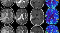 Quantum Technology in Cancer Treatment Uses Electrically Charged Molecules To Trigger Self-Destruction in Brain Tumors