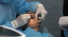 Root Canal Treatment for Tooth Pain Relief in Vero Beach